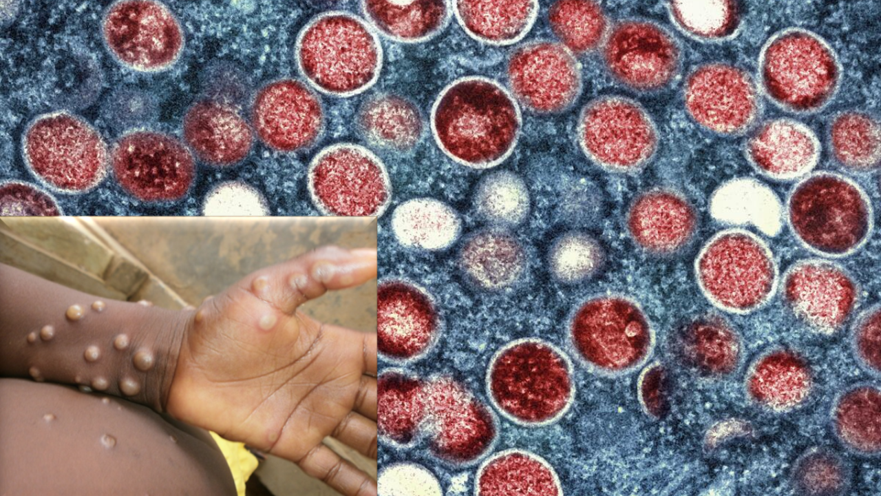 Could Mpox Be the Next Pandemic? What We Know About the New Strain Spreading in Europe!